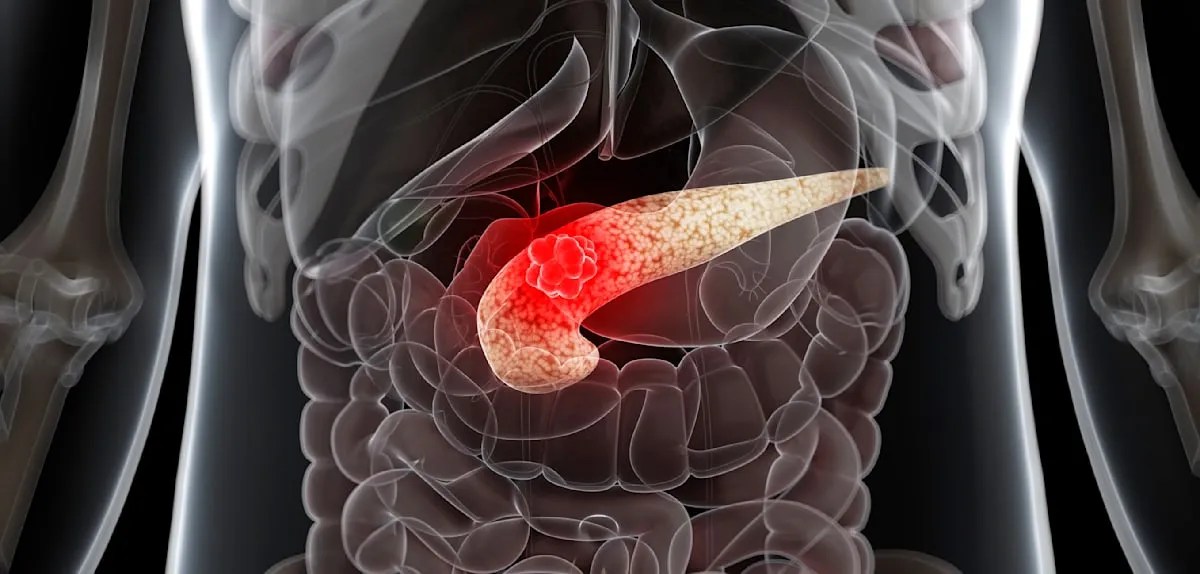 Pancreatic Cancer Scourge: When Will Breakthrough Treatments Emerge in 2026?